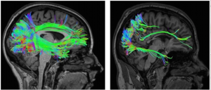 Brain images of ocular VI and CVI